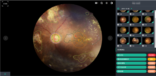 10秒钟出眼底诊断报告 准确率超过90% 青岛眼科医院引入人工智能眼底