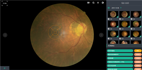 10秒钟出眼底诊断报告 准确率超过90% 青岛眼科医院引入人工智能眼底