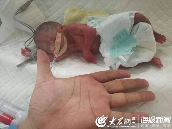 24周早产儿“闯关”出院 出生仅600g破滨州新生儿体重记录|