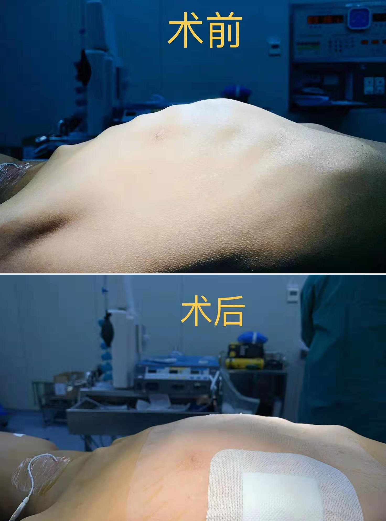 江西省儿童医院开展微创鸡胸矫治手术