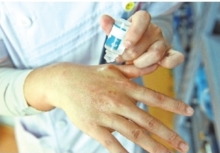 武汉血液中心工作人员林雅琼因长时间佩戴手套，手上长满了疹子。长江日报记者苗剑摄