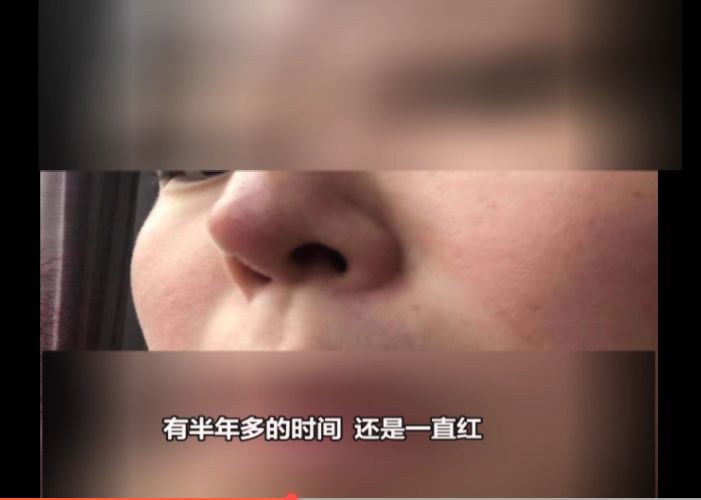 合肥到亚典美容医院隆鼻术后鼻尖发红突起