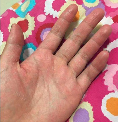 手指皲裂湿疹怎么办?找到具体的诱发原因很重要