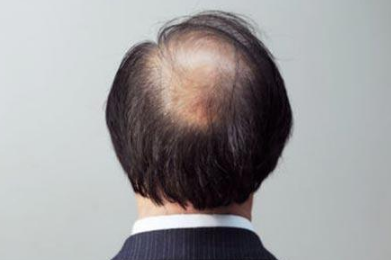 秃顶指日可待 南京新生植发告诉你脱发秃顶究竟该怎么