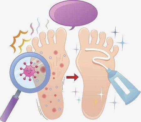脚气用什么药膏效果好 根除脚气还要做到这几点