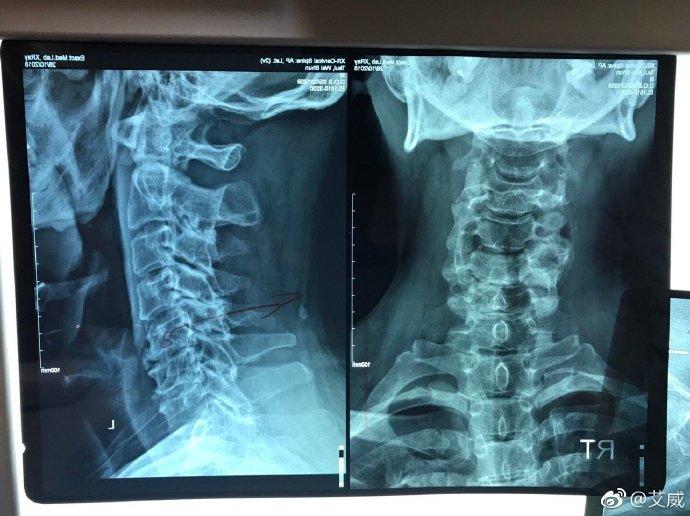 「会火」“金牌绿叶”艾威曝近况略显穷酸：妻子患癌生活窘迫，仍资助孩子