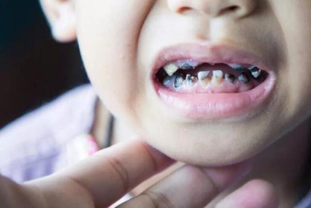2岁男孩牙齿变黑,家长互相指责对方,医生却说是父母无