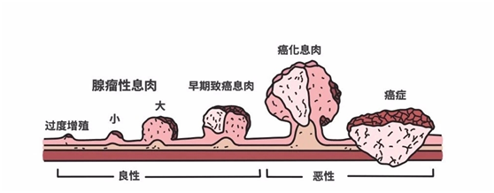 图中为息肉的发展历程,不去发现,不去干预,它的结局确实有点可怕.