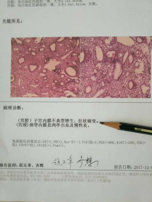 请注意:子宫腺肌症恶变的3大高危因素