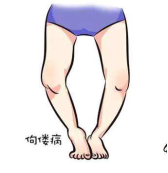 病例分享|佝偻病o型腿畸形矫正5个月