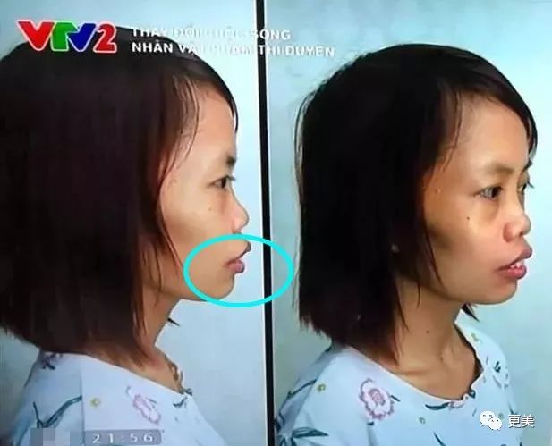 医生给她进行了正畸 正颌手术,对过度发育的上颌骨进行了切除 内推