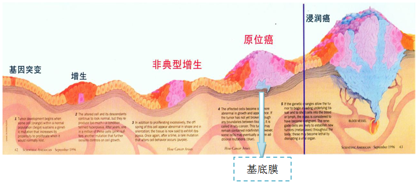 原位癌原发癌浸润癌转移癌傻傻分不清