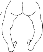 病例分享|佝偻病o型腿畸形矫正5个月