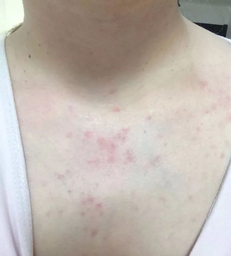 胸背部长红点,起疙瘩是怎么回事呢?