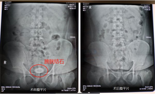 19岁胖小伙爱吃肉不运动,年纪轻轻患上膀胱结石