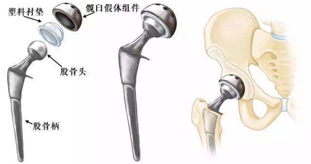 髋关节置换|人工髋关节什么样子的 人工髋关节的使用寿命是多长