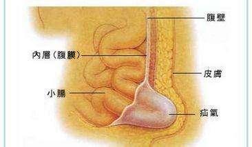 疝气形成的详细过程,都说宝宝疝气1岁前能自愈,具体该