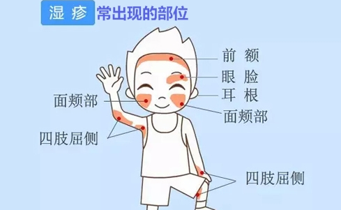 得了湿疹怎么办?湿疹高发期,这些事可能成“元凶”!