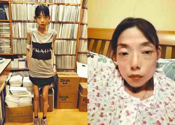 「不八卦会死星人」最惨正宫！遭抛弃牙齿全掉暴瘦到44斤，今病情严重卖收藏凑药钱