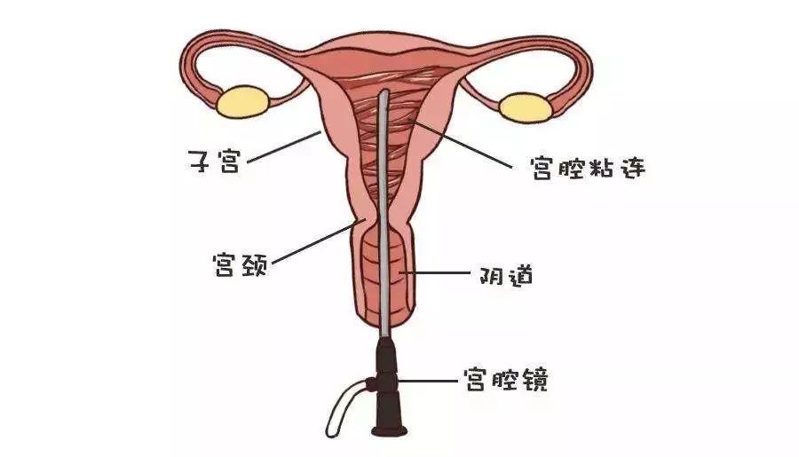 注意!90%的宫腔粘连因它而起