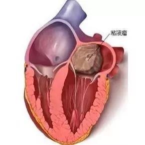 女子心脏长了50毫米的“炸弹”，医生3小时拆“弹”
