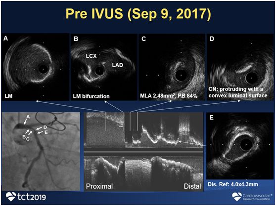 tct2019丨聂绍平团队:ivus指导下旋磨处理钙化小结一例