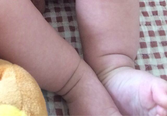 腿纹不对称给宝宝洗完澡后,妈妈可以观察一下宝宝臀部和大腿处的纹路