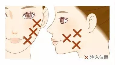 科普| 打瘦脸针,脸会凹陷?变松吗?