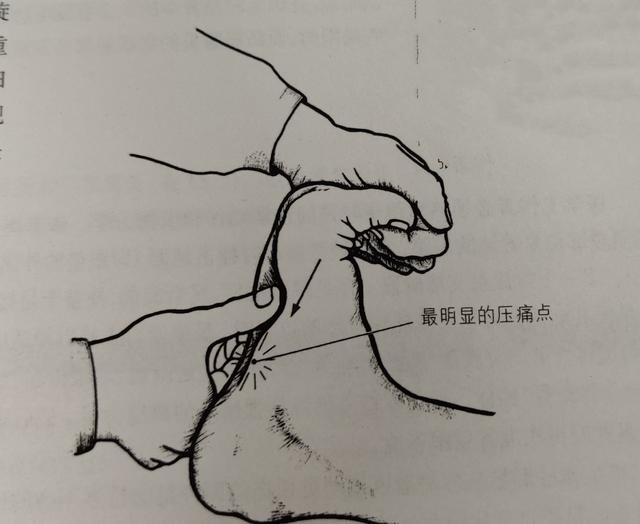 4,肥胖导致承受压力过大 5,足背屈不足:小腿三头肌紧张,跟腱紧张 6