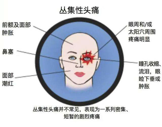 得了丛集性偏头痛怎么办？先了解再治疗是最好的打开方式凤凰网