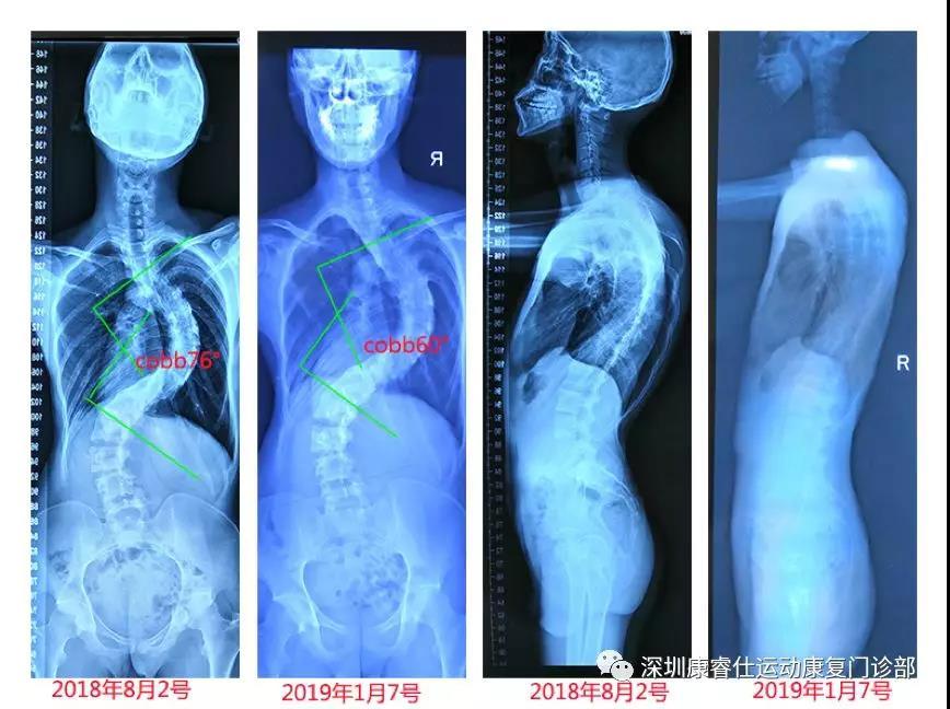 分享一个76度脊柱侧弯改善案例,希望可以帮到有需要的