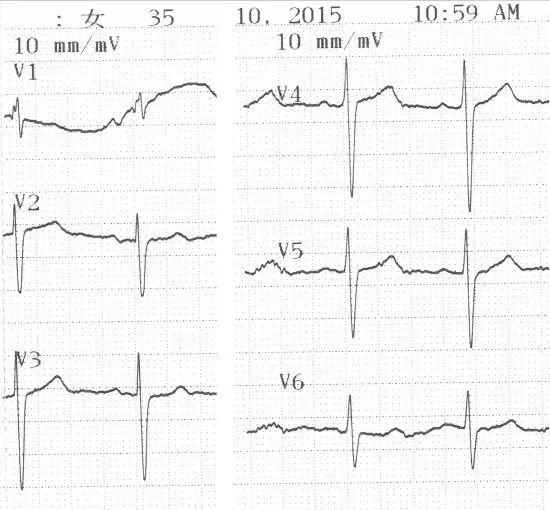 心电图来鉴别(4)——右心衰合并呼吸衰竭