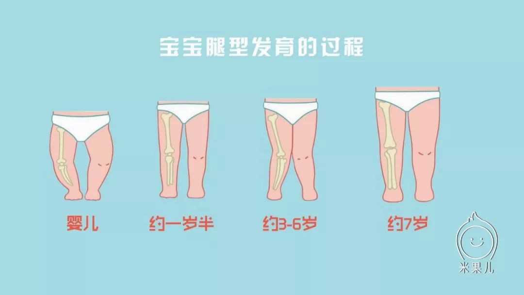 婴幼儿有o型腿或内八字需要治疗吗不少家长急坏了