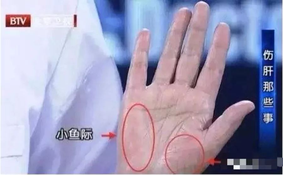 3,大小鱼际无充血