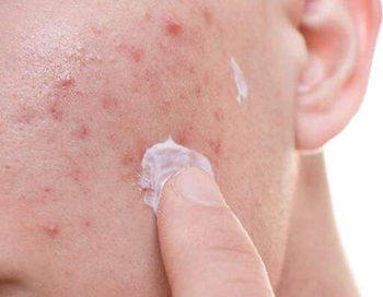 总长痘痘是敏感肌肤吗 解读痘肌和敏感肌区别