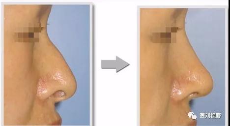 这是侧面图.鼻中隔延长术可以提升鼻头并改变鼻小柱的位置.