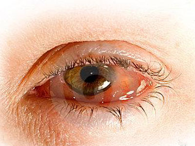 引起的结膜炎症,通常是由用眼过度,手部不清洁而揉搓眼部等原因引发