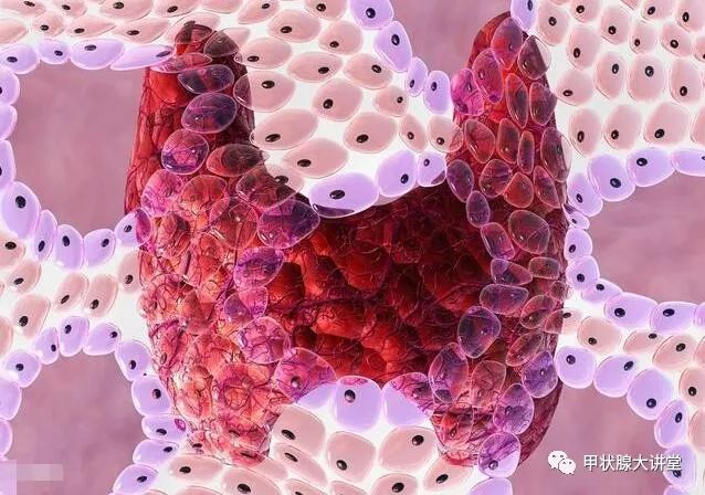 甲状腺乳头状癌一般能活多久?有超过10年的吗?