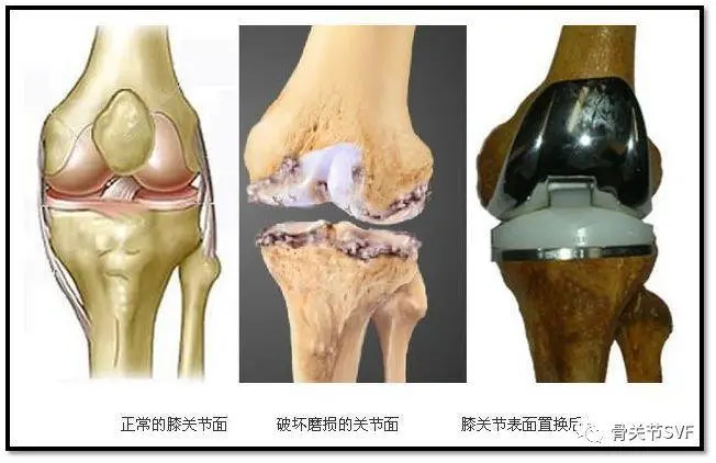 关节损伤修复新技能之svf软骨再生疗法