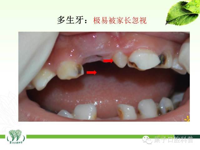 如果长了多生牙,需要及时看医生拔除,以免多生牙在口腔里的滞留影响