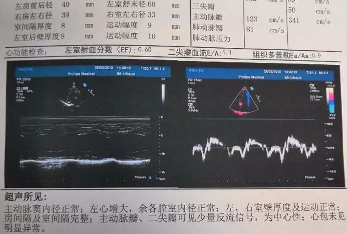 图2. 产后5个月随访超声心动图.