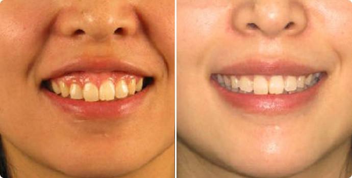 什么是骨性龅牙和牙性龅牙有何不同怎么才能矫正