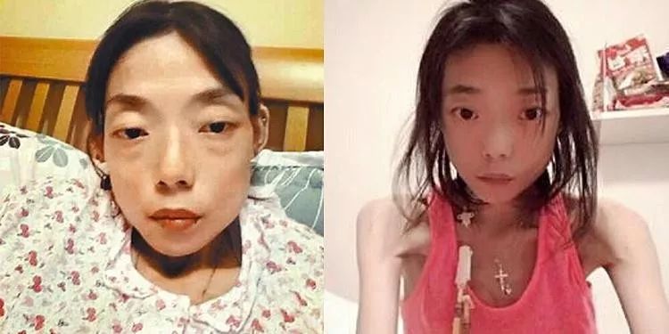 「不八卦会死星人」最惨正宫！遭抛弃牙齿全掉暴瘦到44斤，今病情严重卖收藏凑药钱