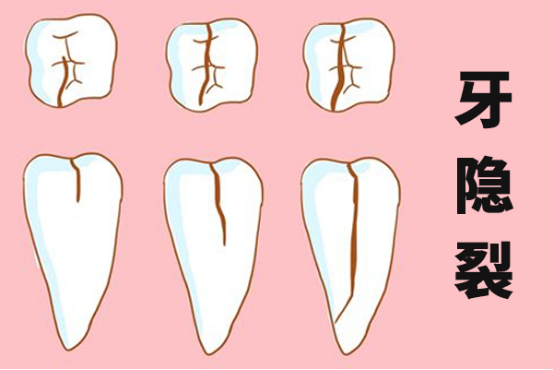 大连齿医生口腔科普 引起牙隐裂的原因有哪些 如何有效判断