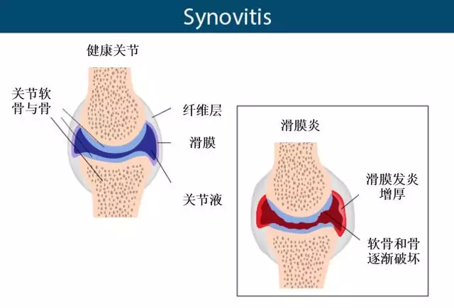 膝关节滑膜炎是怎么回事该如何消除