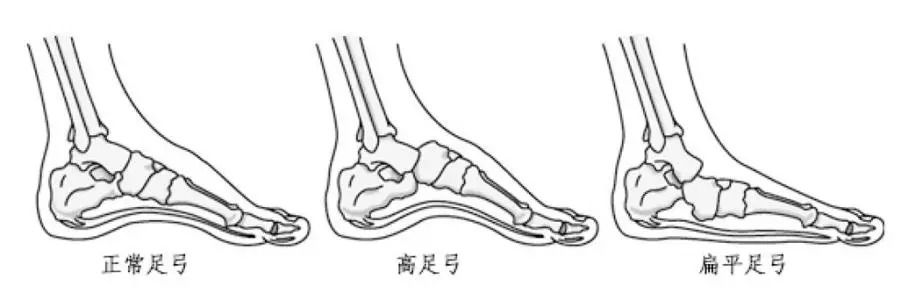 经常脚疼可能和你脚底的一根筋有关