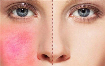 更年期面色潮红潮热应该怎么护理