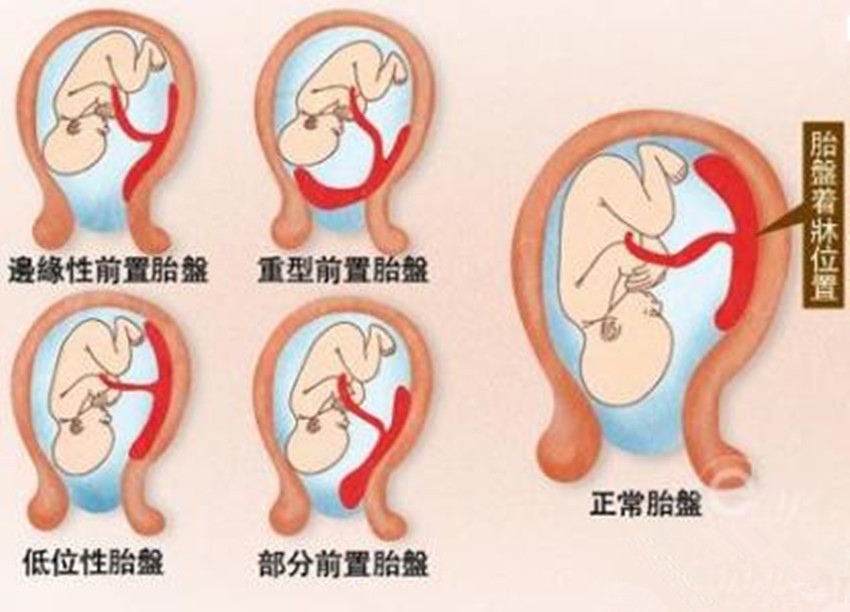 边缘性前置胎盘:胎盘附着于子宫下段,达子宫颈内口边缘,不超越宫颈内