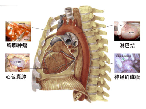 神经源性肿瘤,肠源性囊肿多发生于后纵隔,畸胎瘤,胸腺瘤多发于前纵隔