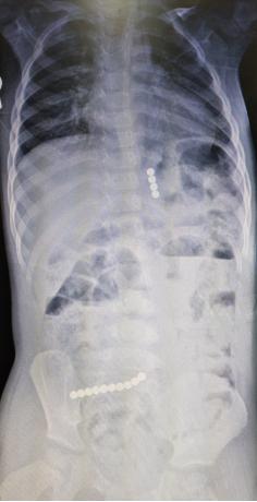 2岁男童吞下14粒磁珠致胃肠多处穿孔,医生连夜手术取出